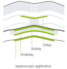 biocade® herni onarımı endikasyonu